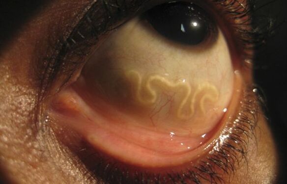 Krimbi Loa Loa jeton në syrin e njeriut dhe shkakton verbëri